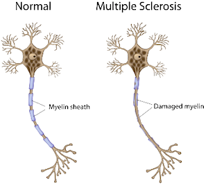 multiple-sclerosis-mylein